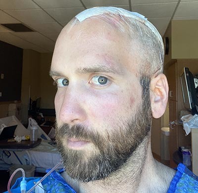 James Hall looking at camera with bandage on brain surgery scar